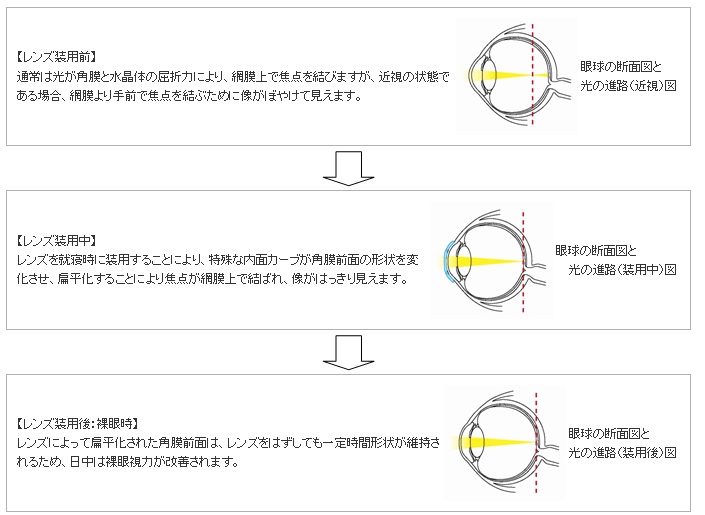 オルソケラトロジー治療の矯正のメカニズム